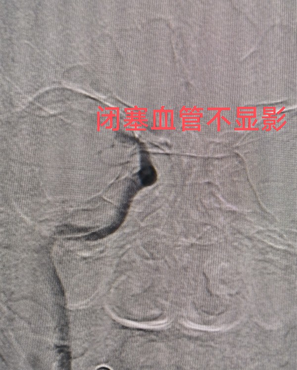 术前造影.png