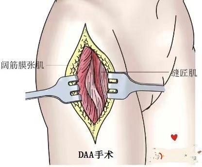 髋关节置换 (2).jpg